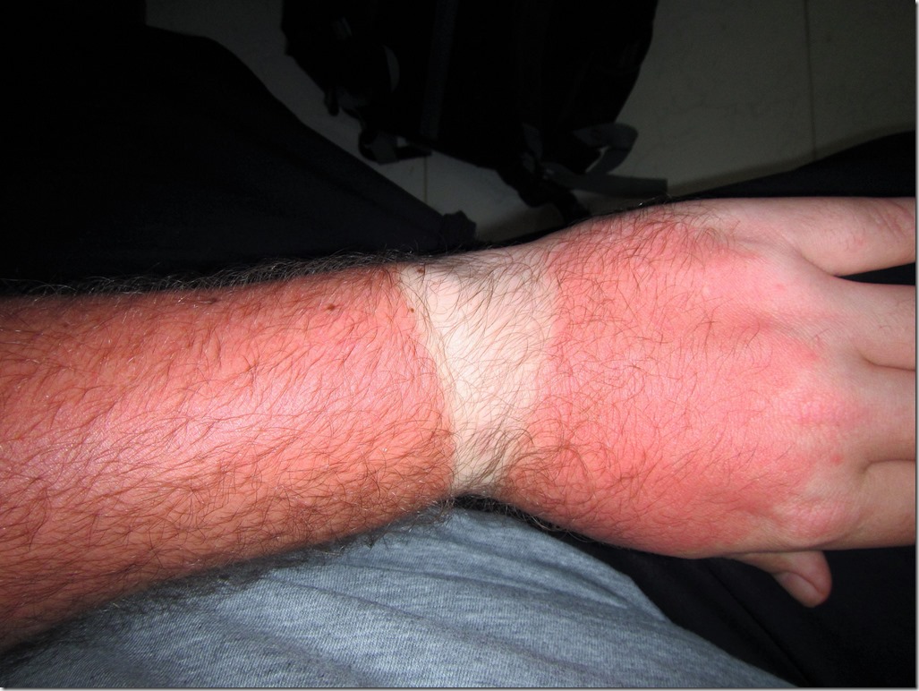 sunburn